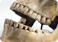 skull with damaged teeth